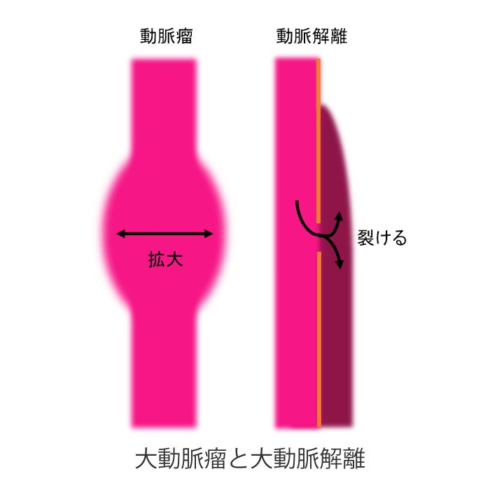 大動脈瘤と大動脈解離|産業医科大学 医学部 心臓血管外科