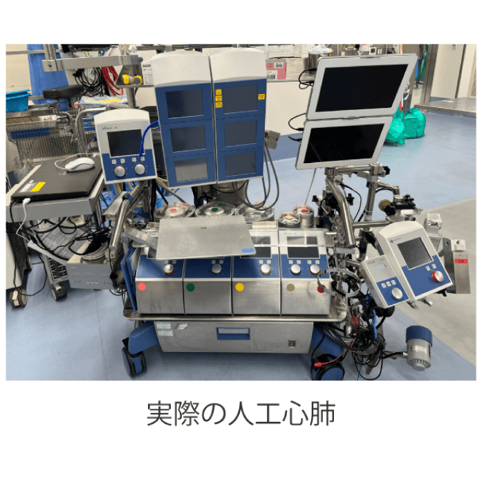 実際の人工心肺|産業医科大学 医学部 心臓血管外科